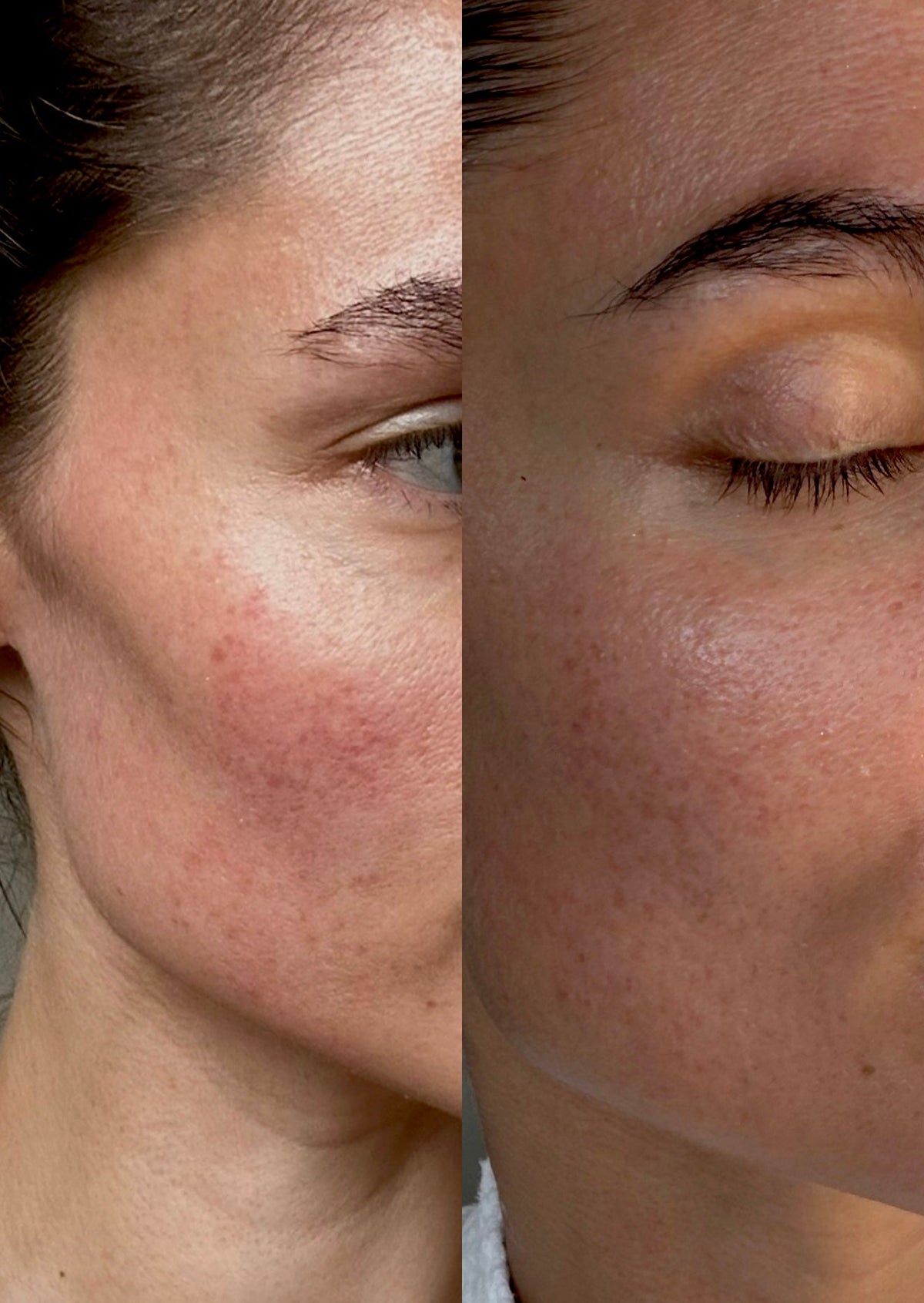 Acne & Hormoner